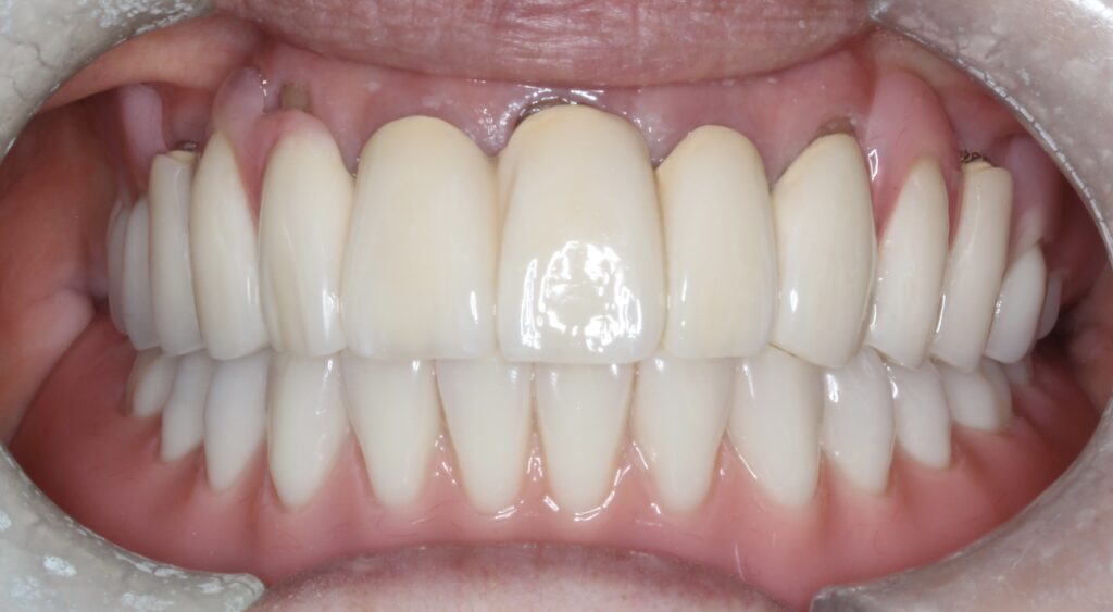 60代女性。歯がぐらついて噛めないので入れ歯を作り直したい。